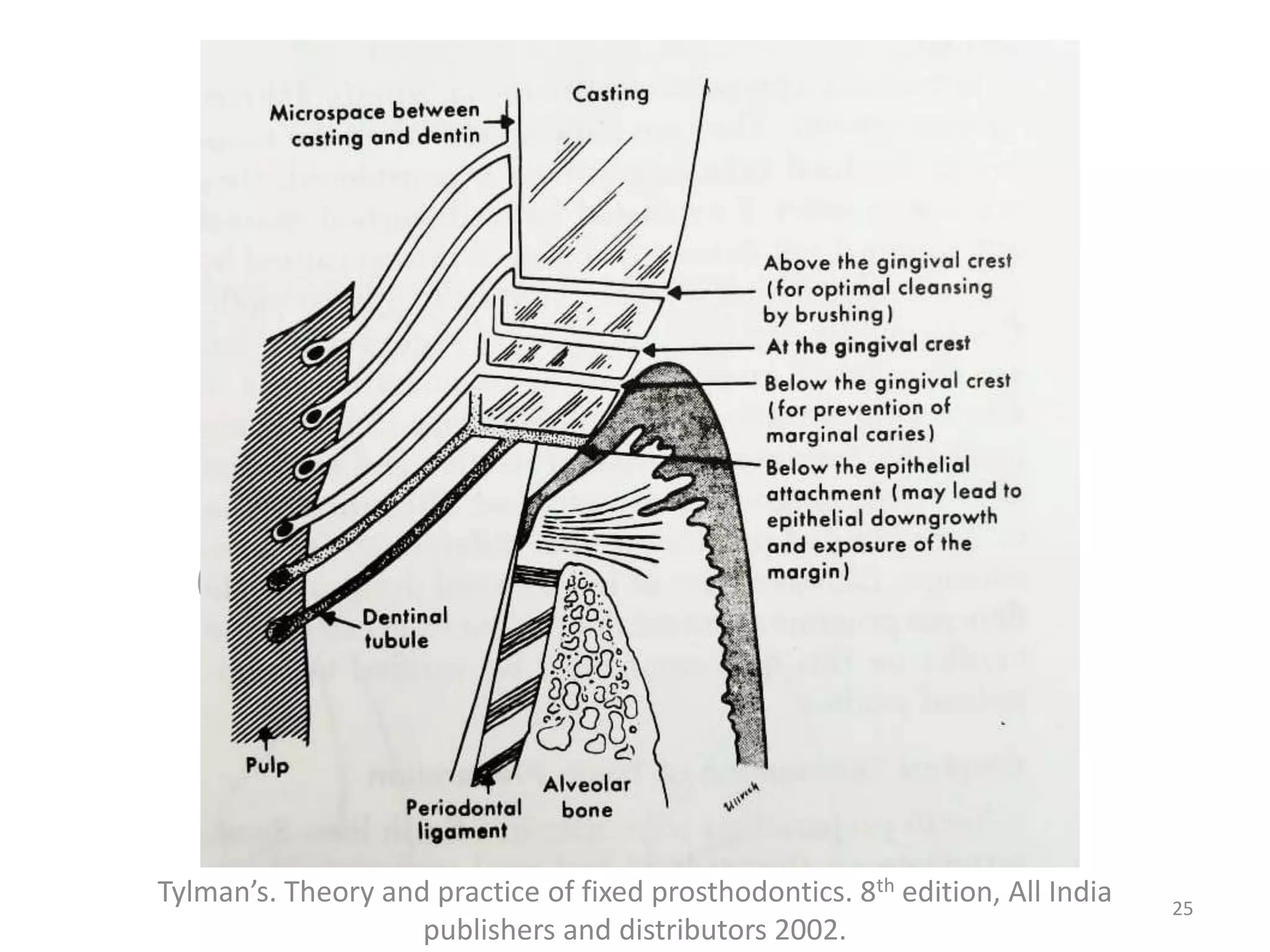Tylman’s. Theory and practice of fixed prosthodontics. 8th edition, All India
publishers and distributors 2002.
25
 