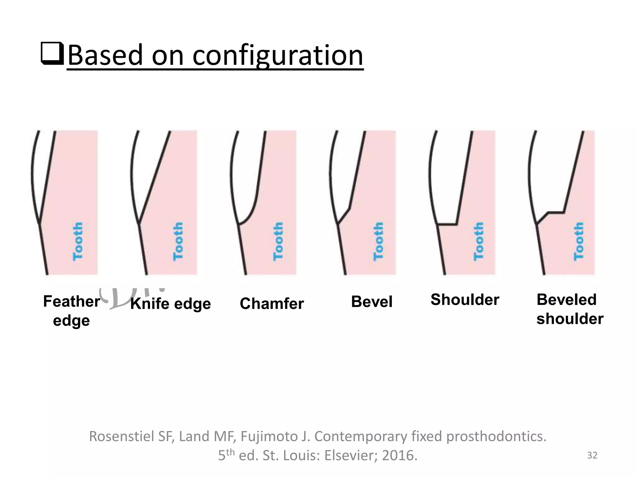 Based on configuration
32
Rosenstiel SF, Land MF, Fujimoto J. Contemporary fixed prosthodontics.
5th ed. St. Louis: Elsevier; 2016.
Feather
edge
Knife edge Chamfer Bevel Shoulder Beveled
shoulder
 