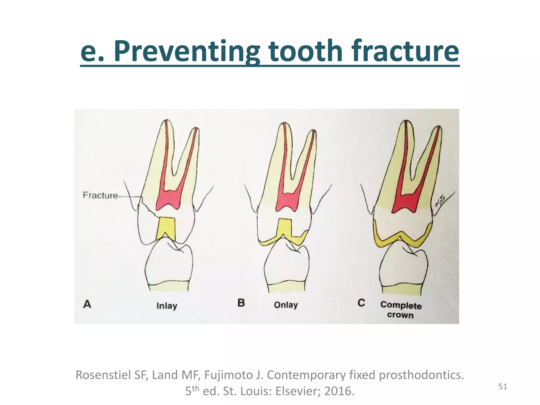 e. Preventing tooth fracture
Rosenstiel SF, Land MF, Fujimoto J. Contemporary fixed prosthodontics.
5th ed. St. Louis: Elsevier; 2016. 51
 