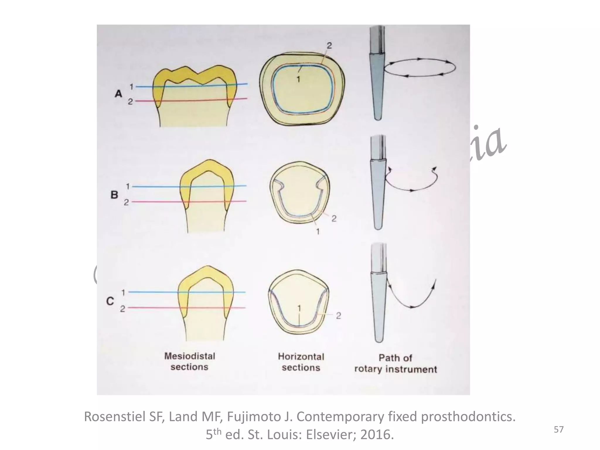 Rosenstiel SF, Land MF, Fujimoto J. Contemporary fixed prosthodontics.
5th ed. St. Louis: Elsevier; 2016. 57
 