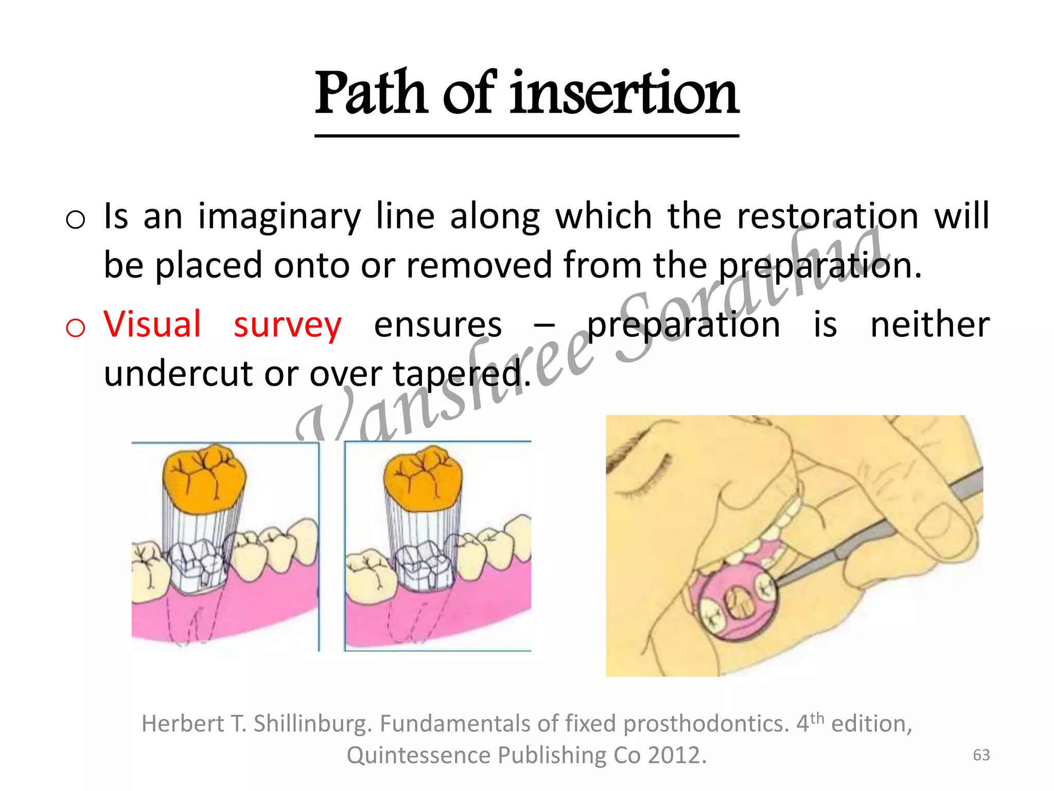 Path of insertion
o Is an imaginary line along which the restoration will
be placed onto or removed from the preparation.
o Visual survey ensures – preparation is neither
undercut or over tapered.
Herbert T. Shillinburg. Fundamentals of fixed prosthodontics. 4th edition,
Quintessence Publishing Co 2012. 63
 