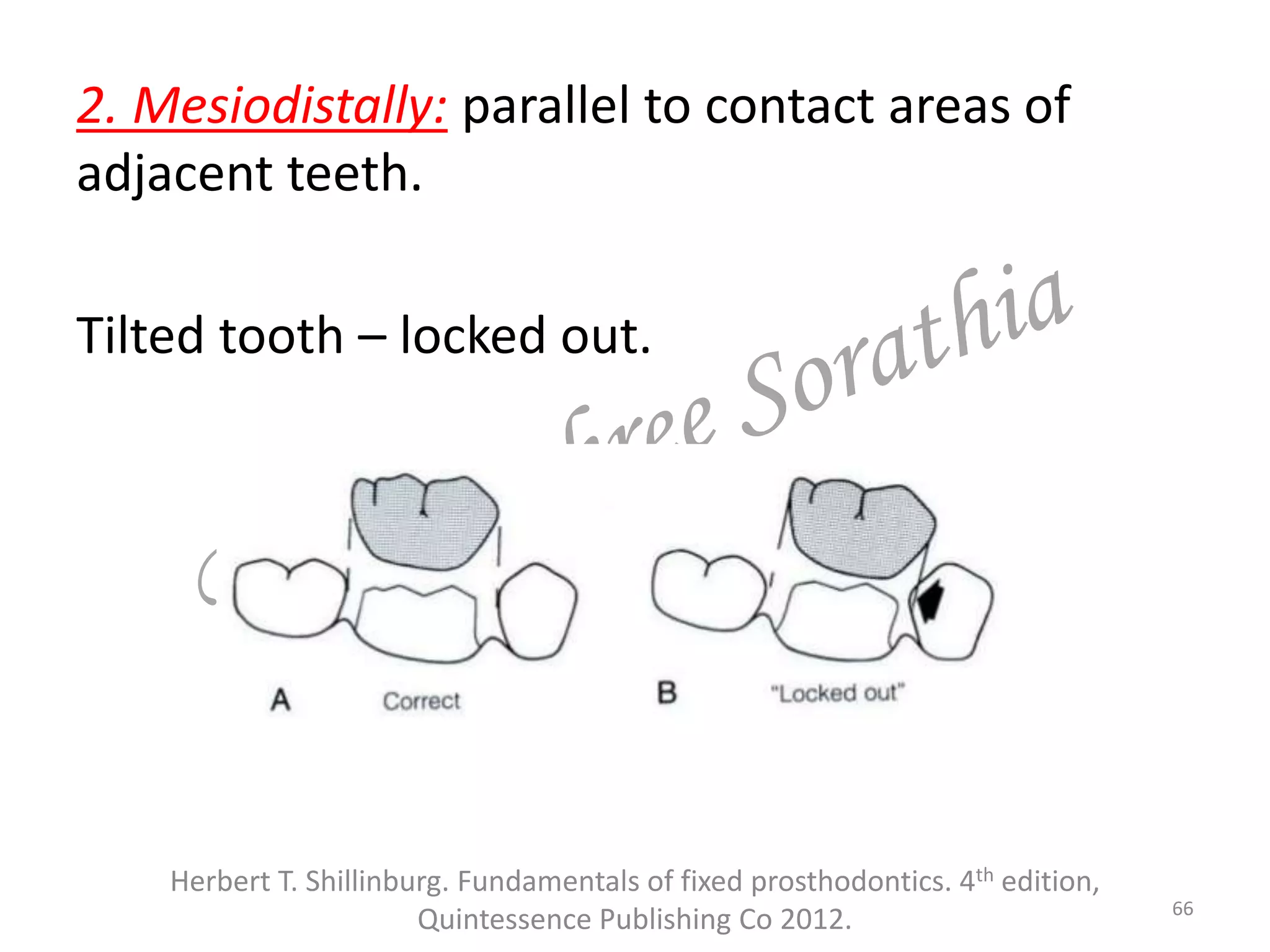 2. Mesiodistally: parallel to contact areas of
adjacent teeth.
Tilted tooth – locked out.
Herbert T. Shillinburg. Fundamentals of fixed prosthodontics. 4th edition,
Quintessence Publishing Co 2012. 66
 