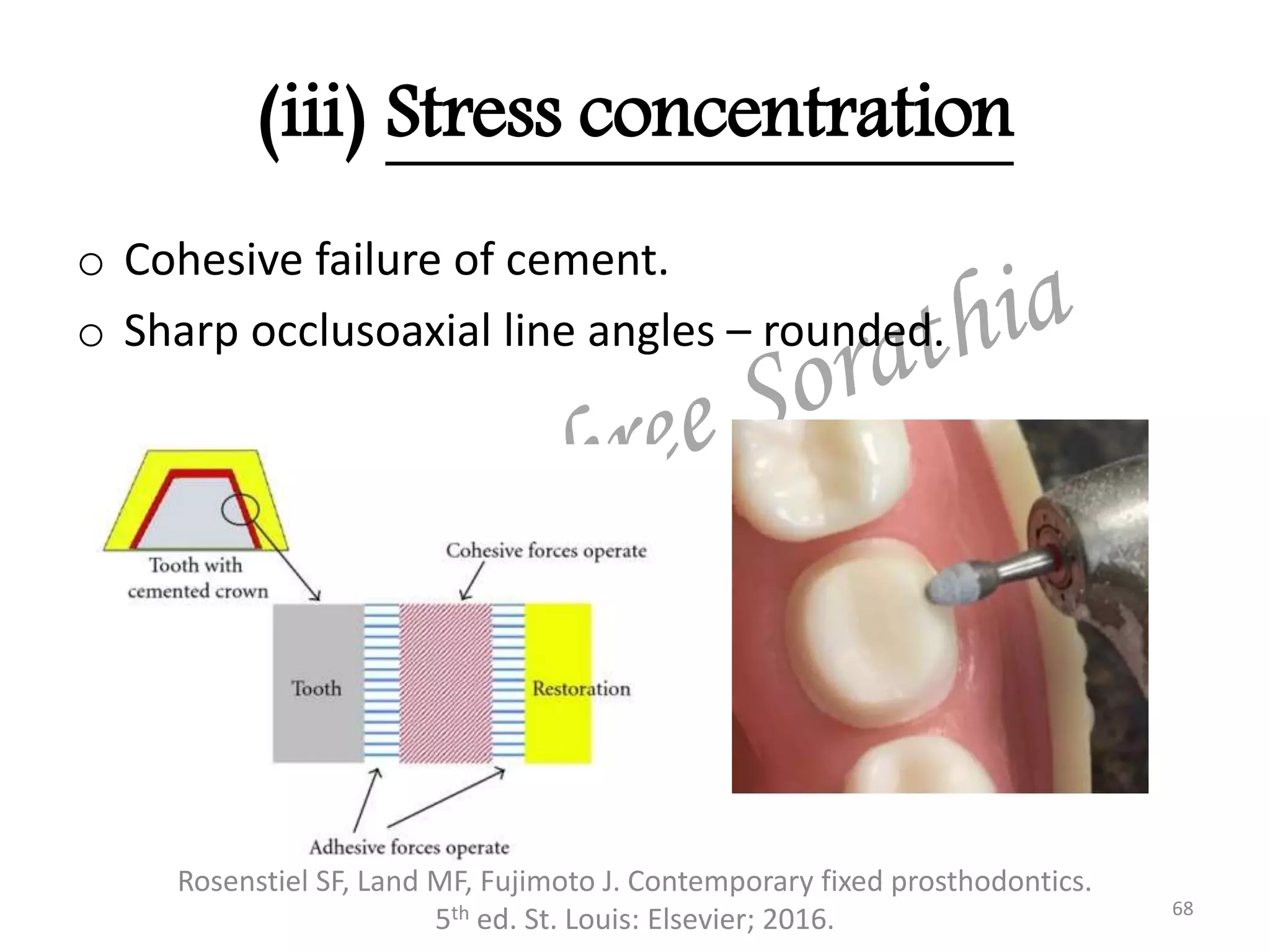 (iii) Stress concentration
o Cohesive failure of cement.
o Sharp occlusoaxial line angles – rounded.
Rosenstiel SF, Land MF, Fujimoto J. Contemporary fixed prosthodontics.
5th ed. St. Louis: Elsevier; 2016. 68
 