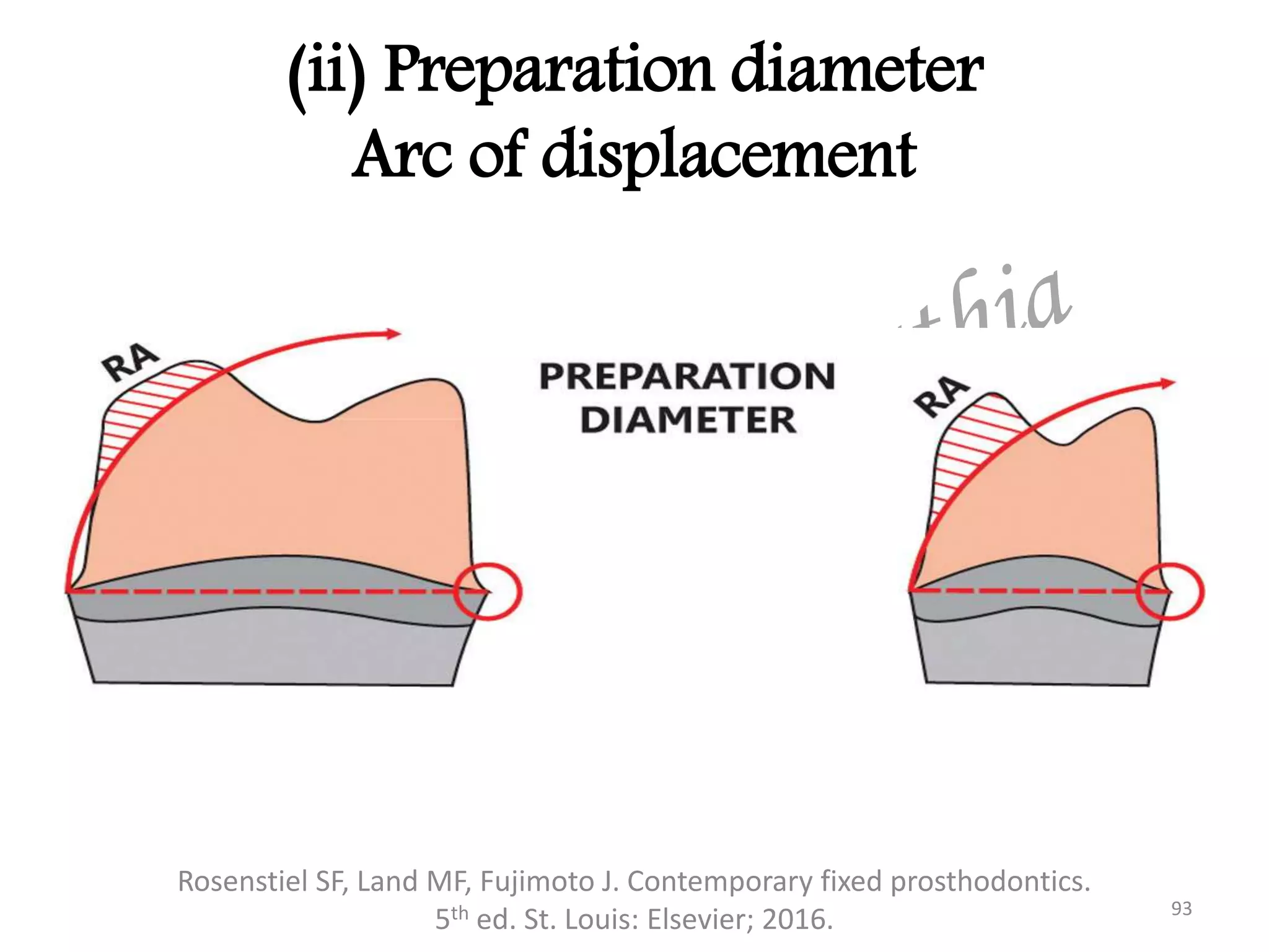 (ii) Preparation diameter
Arc of displacement
Rosenstiel SF, Land MF, Fujimoto J. Contemporary fixed prosthodontics.
5th ed. St. Louis: Elsevier; 2016. 93
 