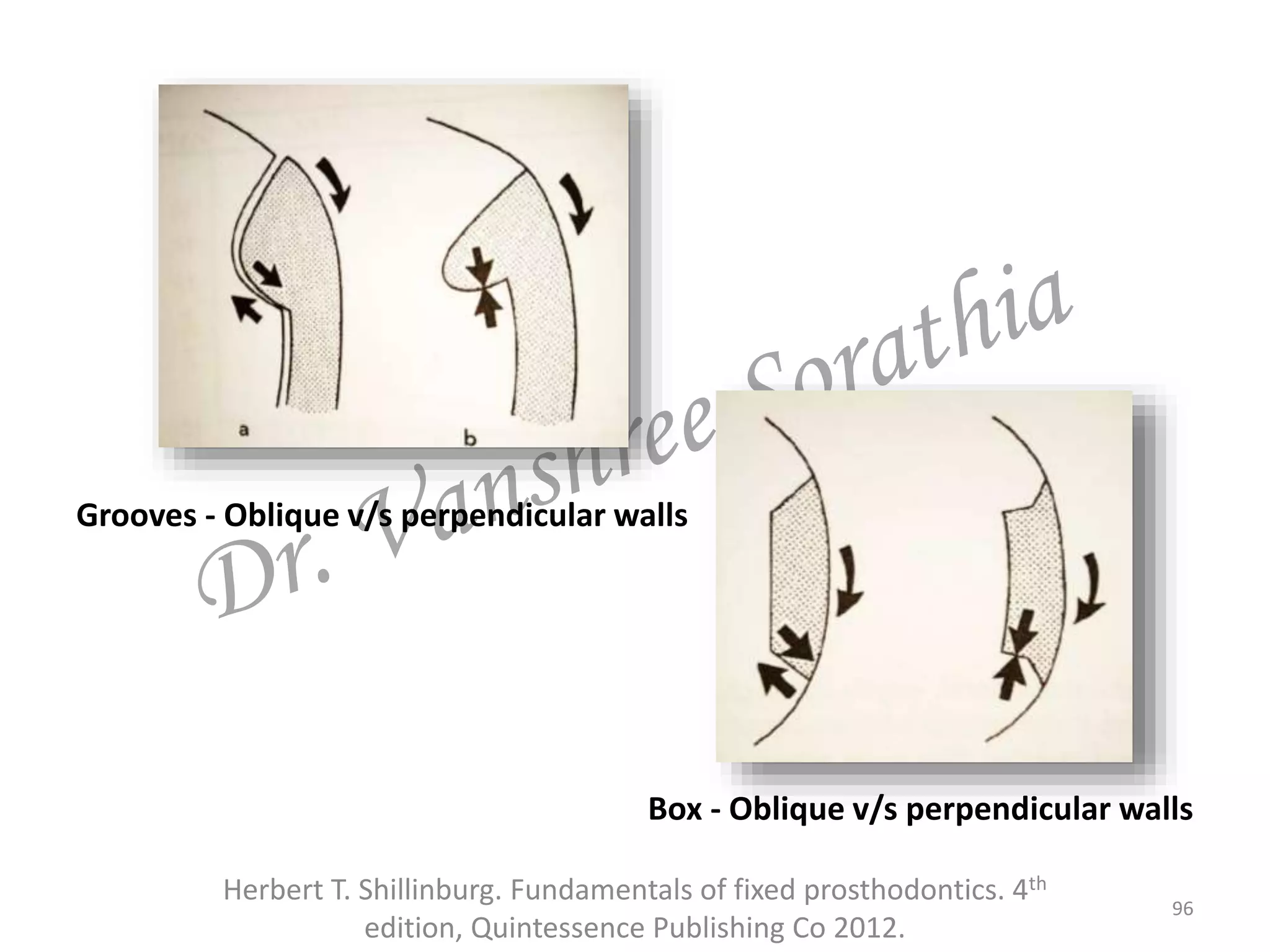 96
Herbert T. Shillinburg. Fundamentals of fixed prosthodontics. 4th
edition, Quintessence Publishing Co 2012.
Grooves - Oblique v/s perpendicular walls
Box - Oblique v/s perpendicular walls
 