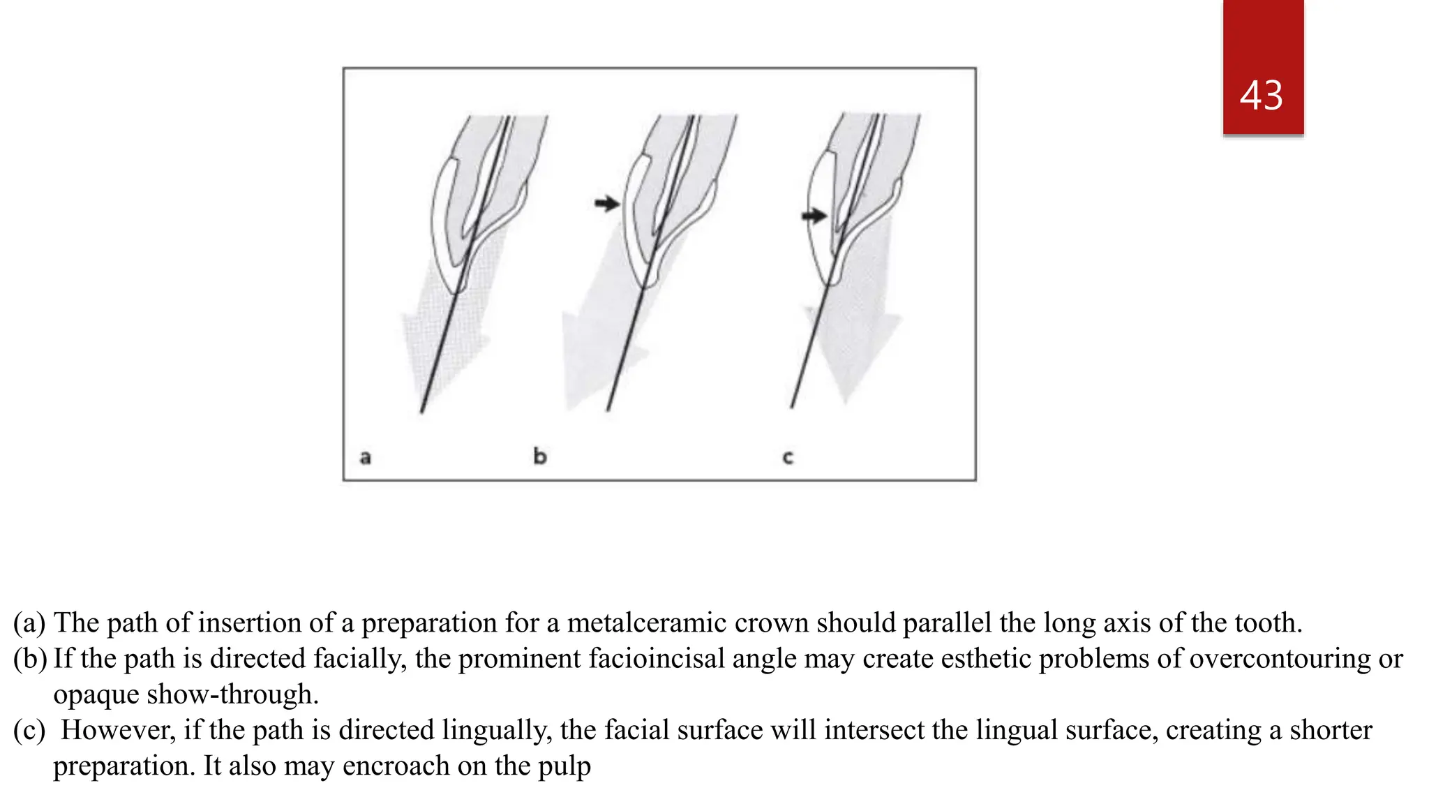 Principles Of Tooth Preparation.pptx