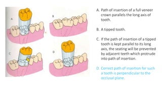 Principles of tooth preparation | PPTX