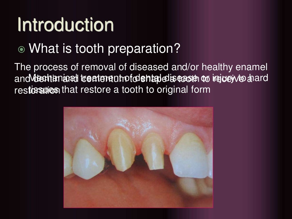 Principles of tooth preparation copy