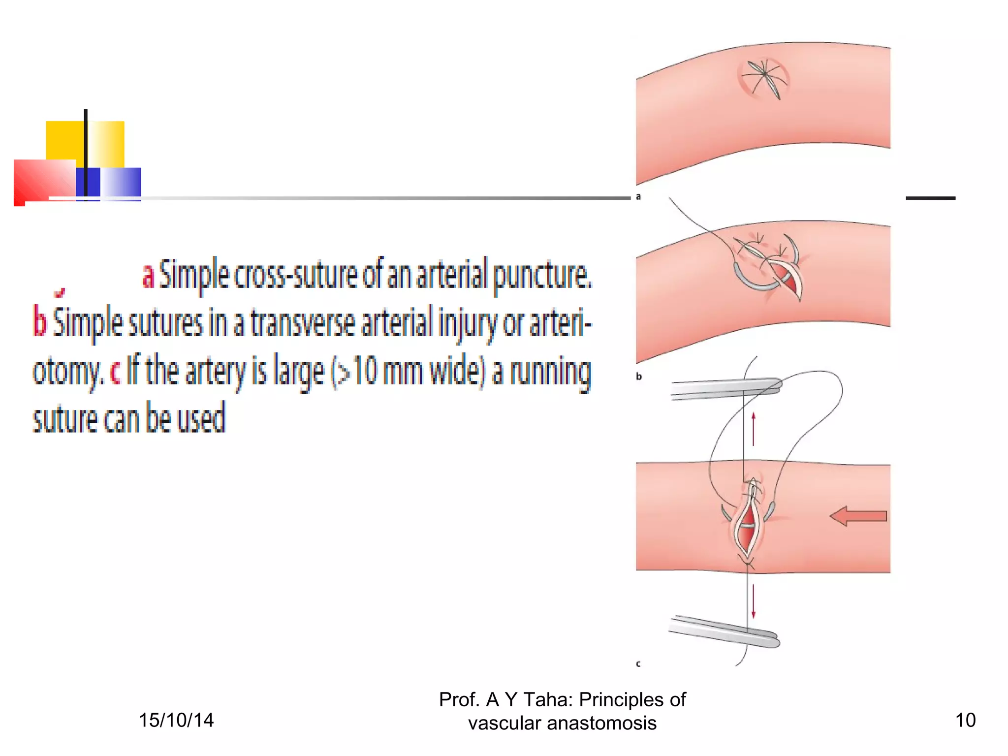 Principles of vascular anastomosis | PPT