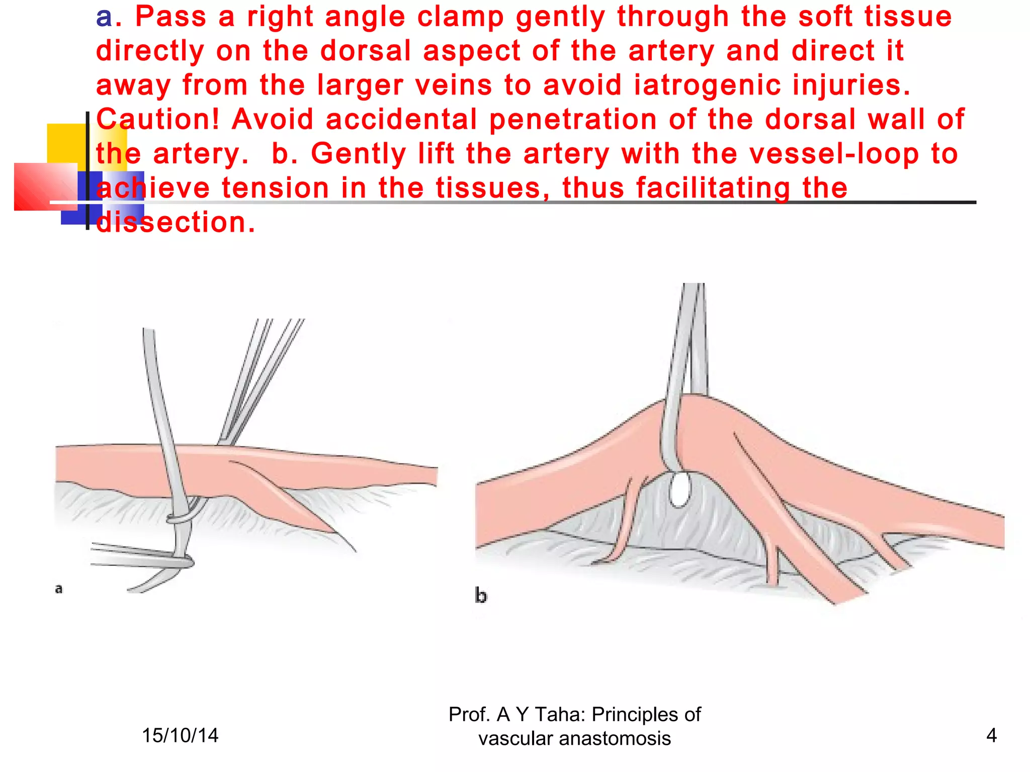 Principles of vascular anastomosis | PPT