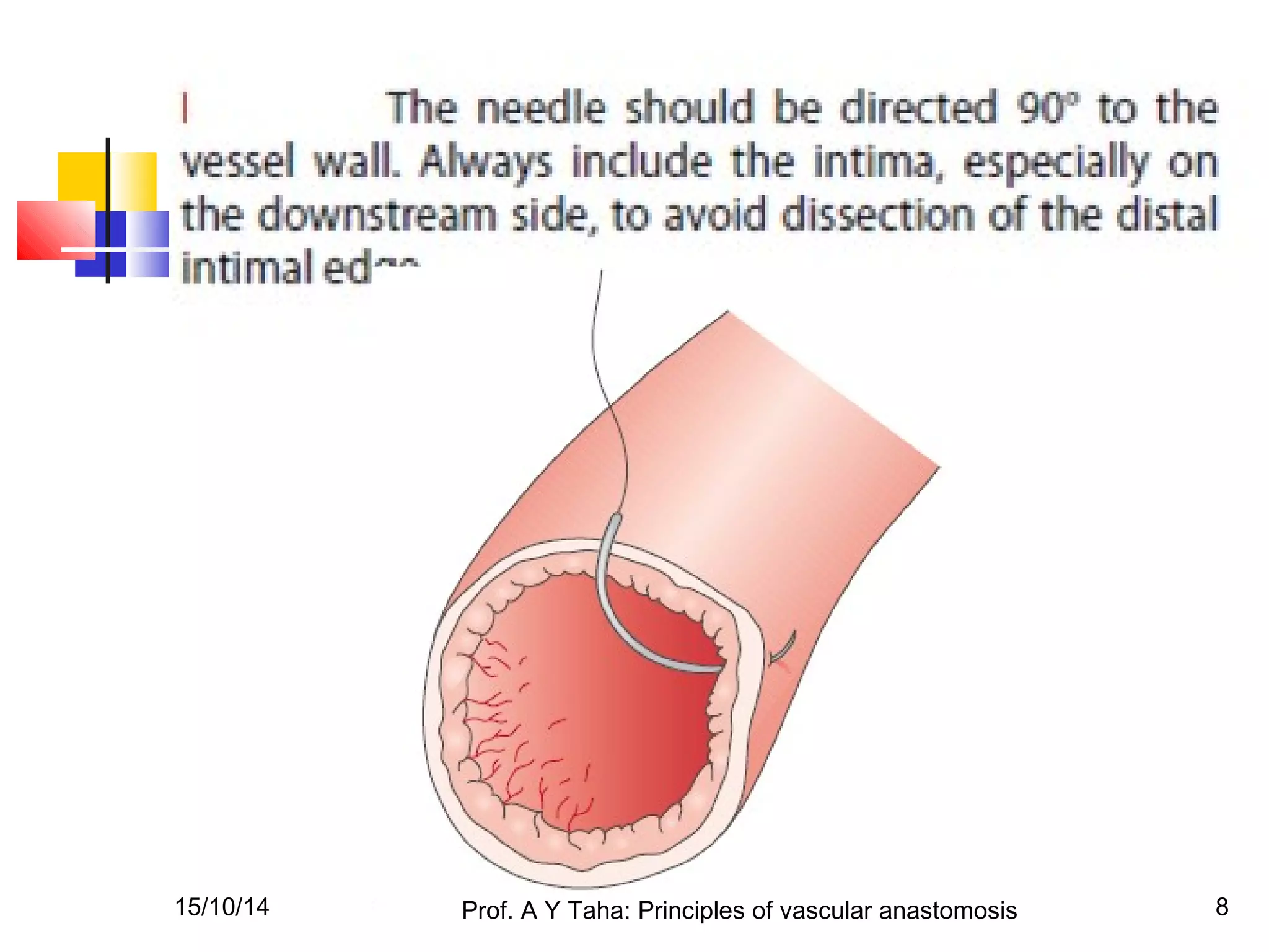 Principles of vascular anastomosis | PPT