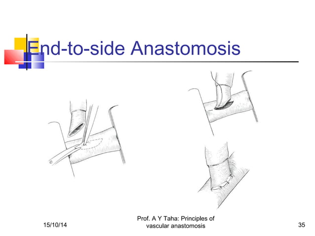 Principles of vascular anastomosis | PPT | First Aid | Injuries