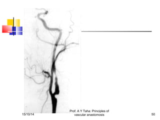 Principles of vascular anastomosis | PPT