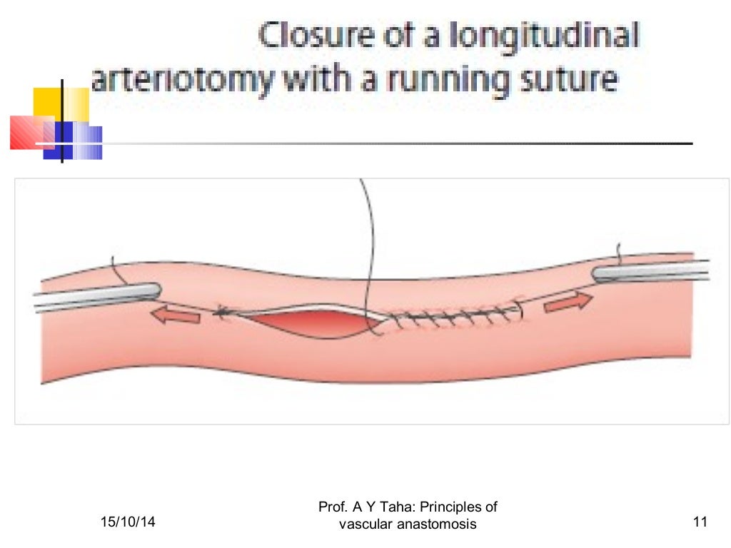 Principles of vascular anastomosis