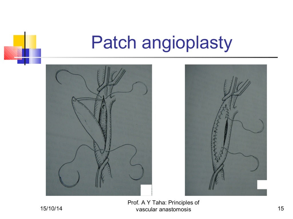 Principles of vascular anastomosis