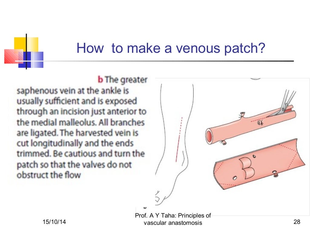 Principles of vascular anastomosis