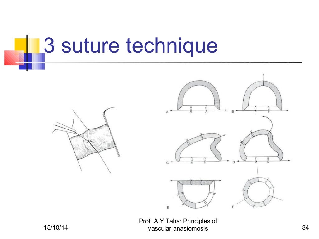 Principles of vascular anastomosis