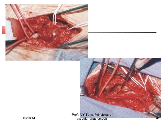 vascular anastomosis