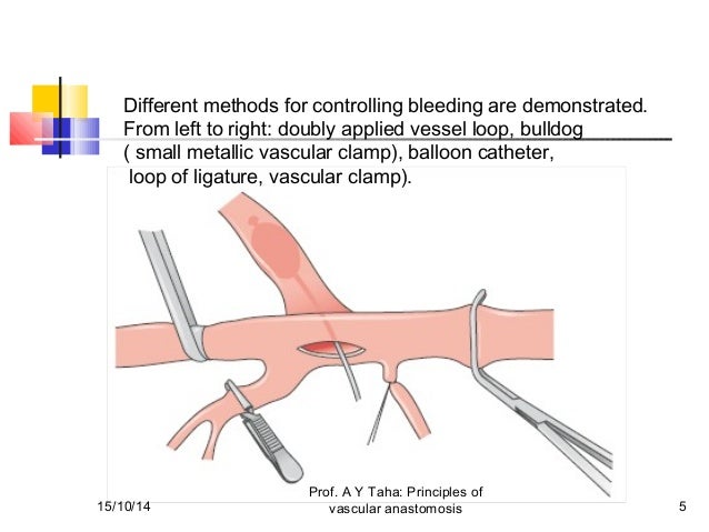 vascular anastomosis
