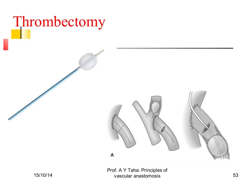Principles of vascular anastomosis