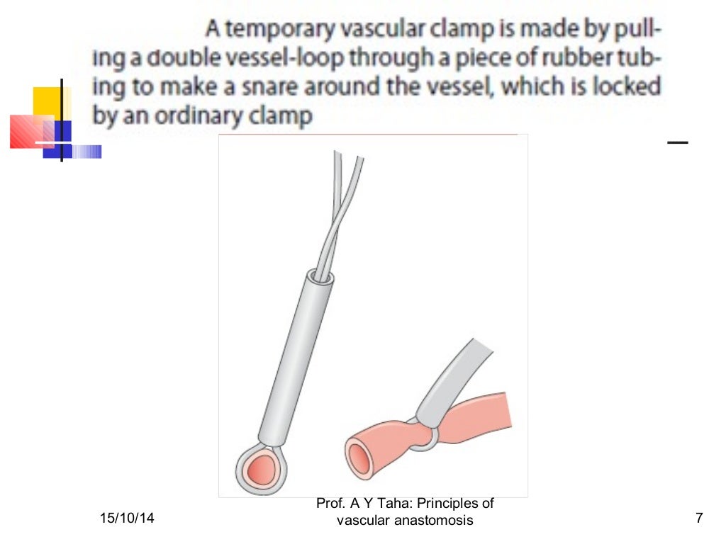 Principles of vascular anastomosis