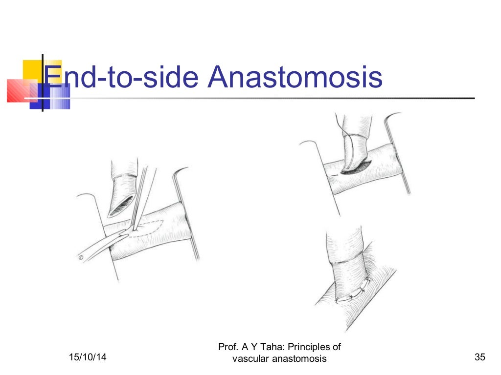 Principles of vascular anastomosis