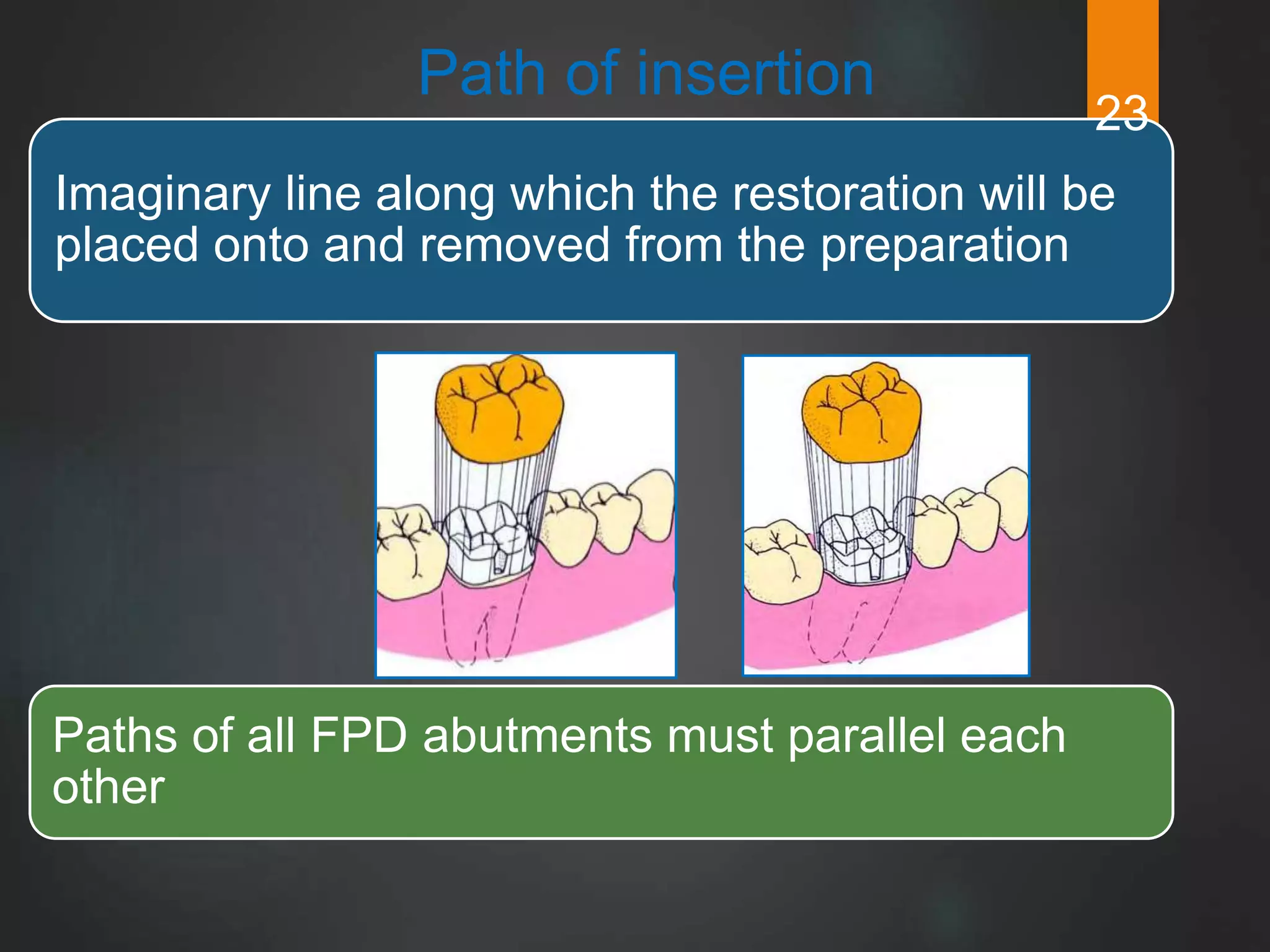 Principles of tooth preparation devi | PPTX