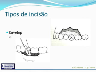 Tipos de incisão
⚫Envelop
e;
 