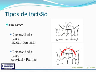 Tipos de incisão
Em arco:
 Concavidade
para
apical - Partsch
 Concavidade
para
cervical - Pichler
 