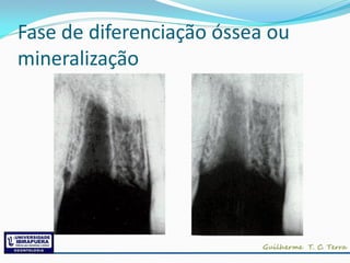 Fase de diferenciação óssea ou
mineralização
 