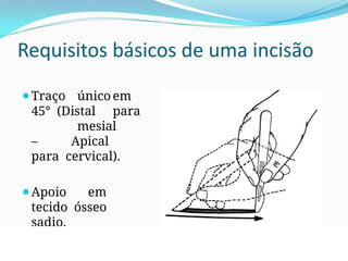 Requisitos básicos de uma incisão
⚫Traço único em
45° (Distal para
mesial
– Apical
para cervical).
⚫Apoio em
tecido ósseo
sadio.
 