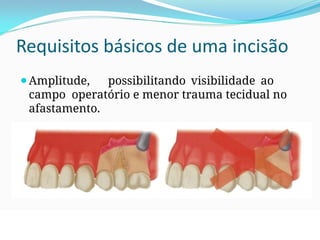 Requisitos básicos de uma incisão
⚫Amplitude, possibilitando visibilidade ao
campo operatório e menor trauma tecidual no
afastamento.
 