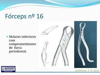 Fórceps nº 16
⚫ Molares inferiores
com
comprometimento
de furca
periodontal.
 