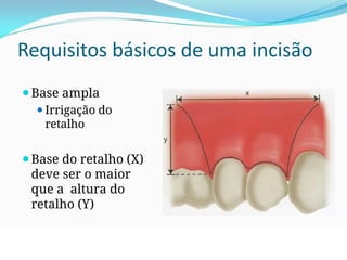 Requisitos básicos de uma incisão
⚫Base ampla
⚫Irrigação do
retalho
⚫Base do retalho (X)
deve ser o maior
que a altura do
retalho (Y)
⚫Idealmente X=2Y
 
