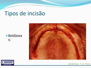 Tipos de incisão
⚫Retilínea
s;
 