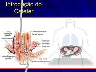 •100
•Esophagus
Introdução do
Cateter
 