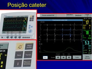 66 75 915 Rev. 00
Posicionamiento correcto
Posição cateter
 