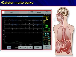 •Cateter muito baixo
 