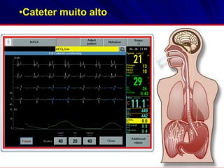 •Cateter muito alto
 