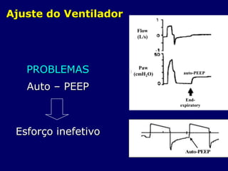 Ajuste do Ventilador
PROBLEMAS
Auto – PEEP
Esforço inefetivo
Flow
(L/s)
Paw
(cmH2O)
End-
expiratory
auto-PEEP
 