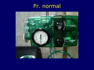 Fr. normal
 