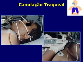 Canulação Traqueal
 
