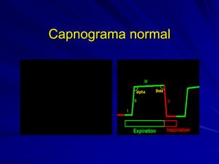 Capnograma normal
 