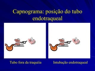 Capnograma: posição do tubo
endotraqueal
Tubo fora da traquéia Intubação endotraqueal
 