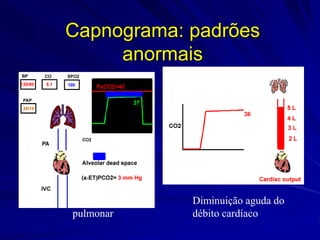 Capnograma: padrões
anormais
Tromboembolismo
pulmonar
Diminuição aguda do
débito cardíaco
 