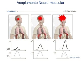 Edi
VT
saudável Enfermidade
Acoplamento Neuro-muscular
•μV •μV •μV
•ml •ml •ml
•66 75 915 Rev. 00
 