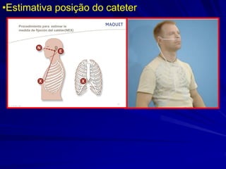 •Estimativa posição do cateter
66 75 915 Rev. 00
13
Procedimiento para estimar la
medida de fijación del catéter(NEX)
 