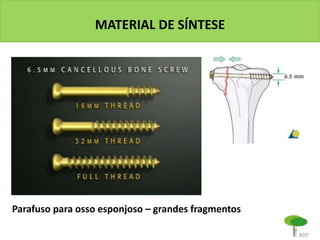 MATERIAL DE SÍNTESE
Parafuso para osso esponjoso – grandes fragmentos
 