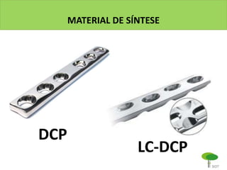 MATERIAL DE SÍNTESE
DCP
LC-DCP
 