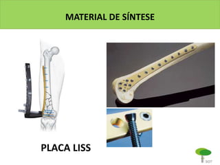 MATERIAL DE SÍNTESE
PLACA LISS
 